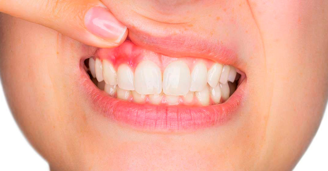 La periodontitis o enfermedad de las encías