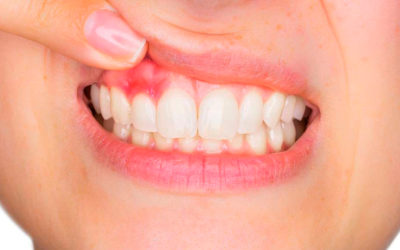 La periodontitis o enfermedad de las encías