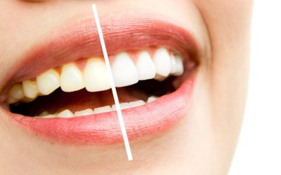 Essentials for the Esthetic Dentist