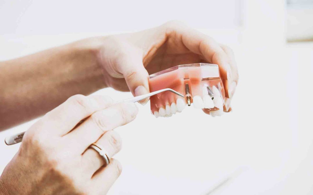 Dientes fijos en un día