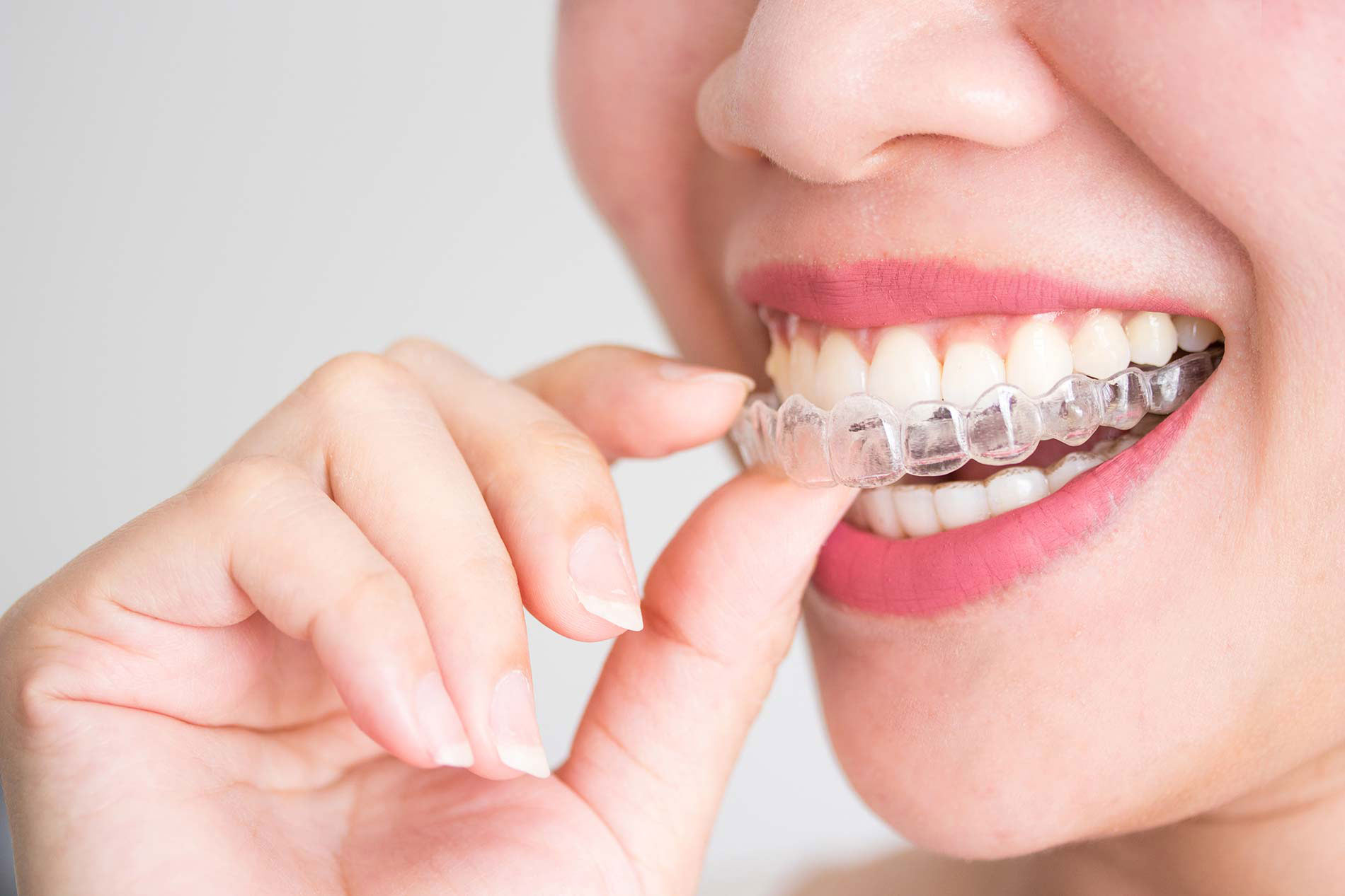 papel detective Activar Cuidados durante y tras el tratamiento con ortodoncia - Catarroja Dental