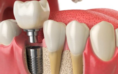 Implantes dentales: respuestas a las dudas más frecuentes