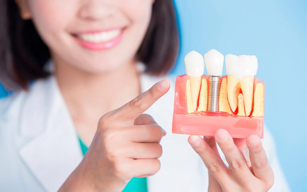 Cuidados postoperatorios para después de una cirugía de implantes dentales