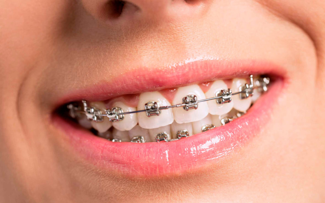 ¿Qué es un microimplante dental?