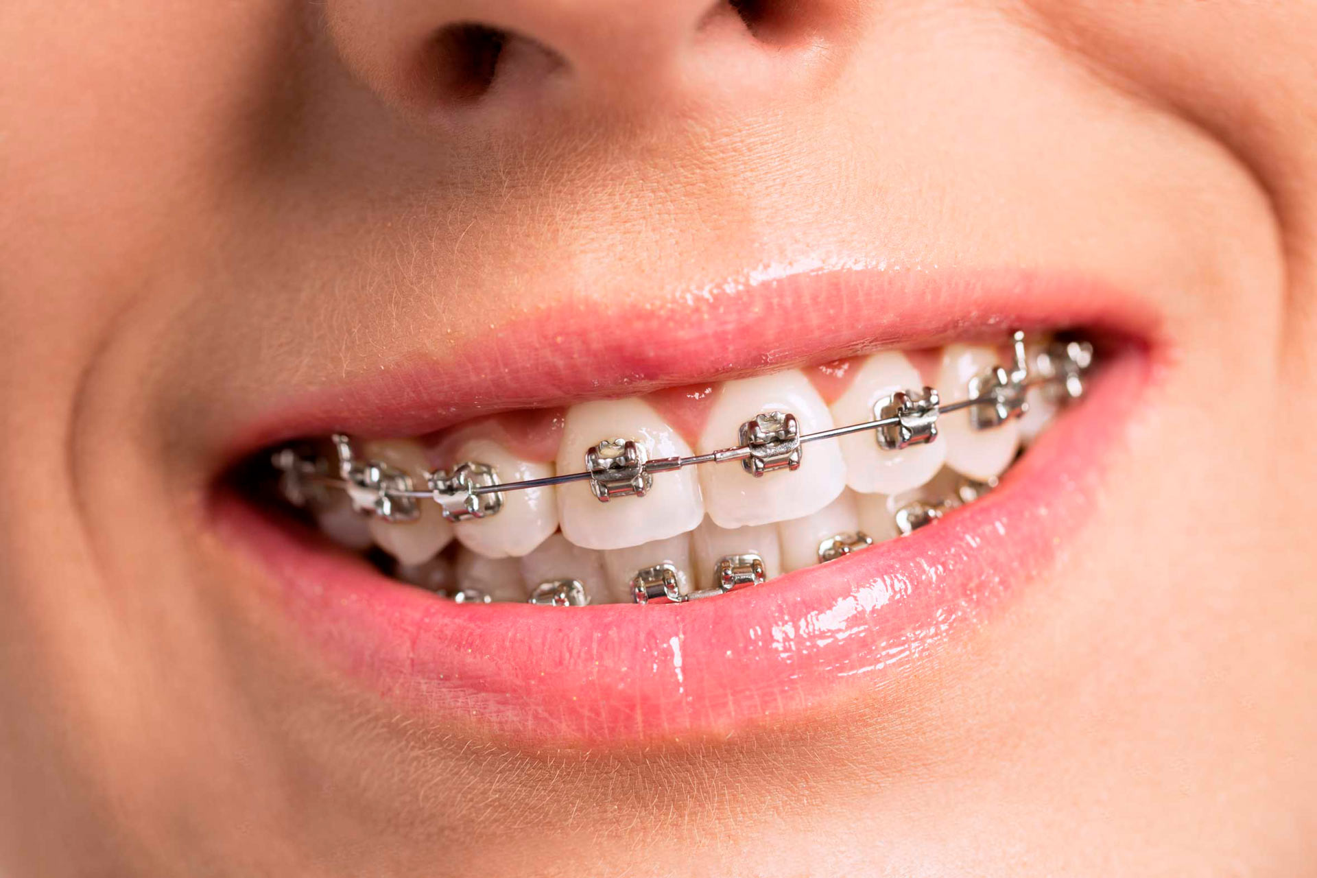 Брекеты на зубы для детей сколько стоят. Металлические брекеты.