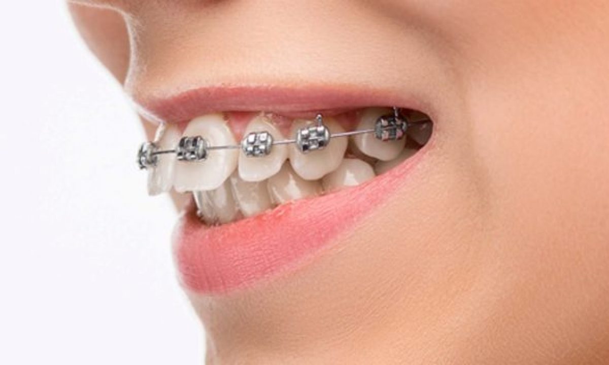 Catarroja Dental blanqueamiento casero